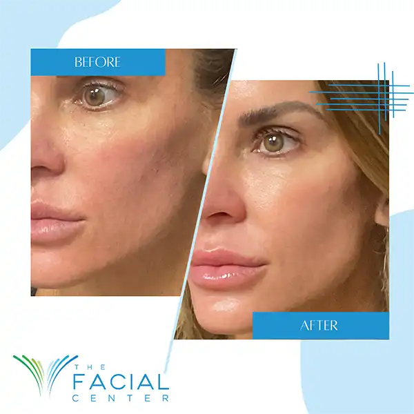 Woman patient's before and after photo from receiving a SKINVIVE™ by JUVÉDERM® treatment at The Facial Center in Charleston, WV