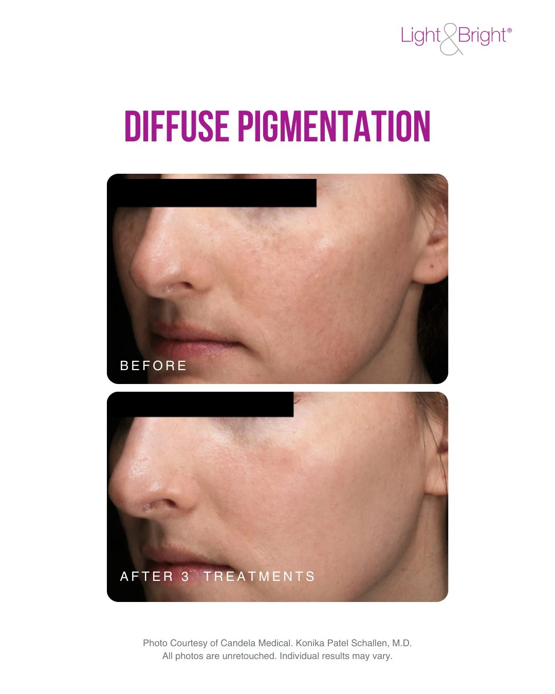 Before and after photos of reduced facial pigmentation and sun damage following three Nordlys IPL treatments