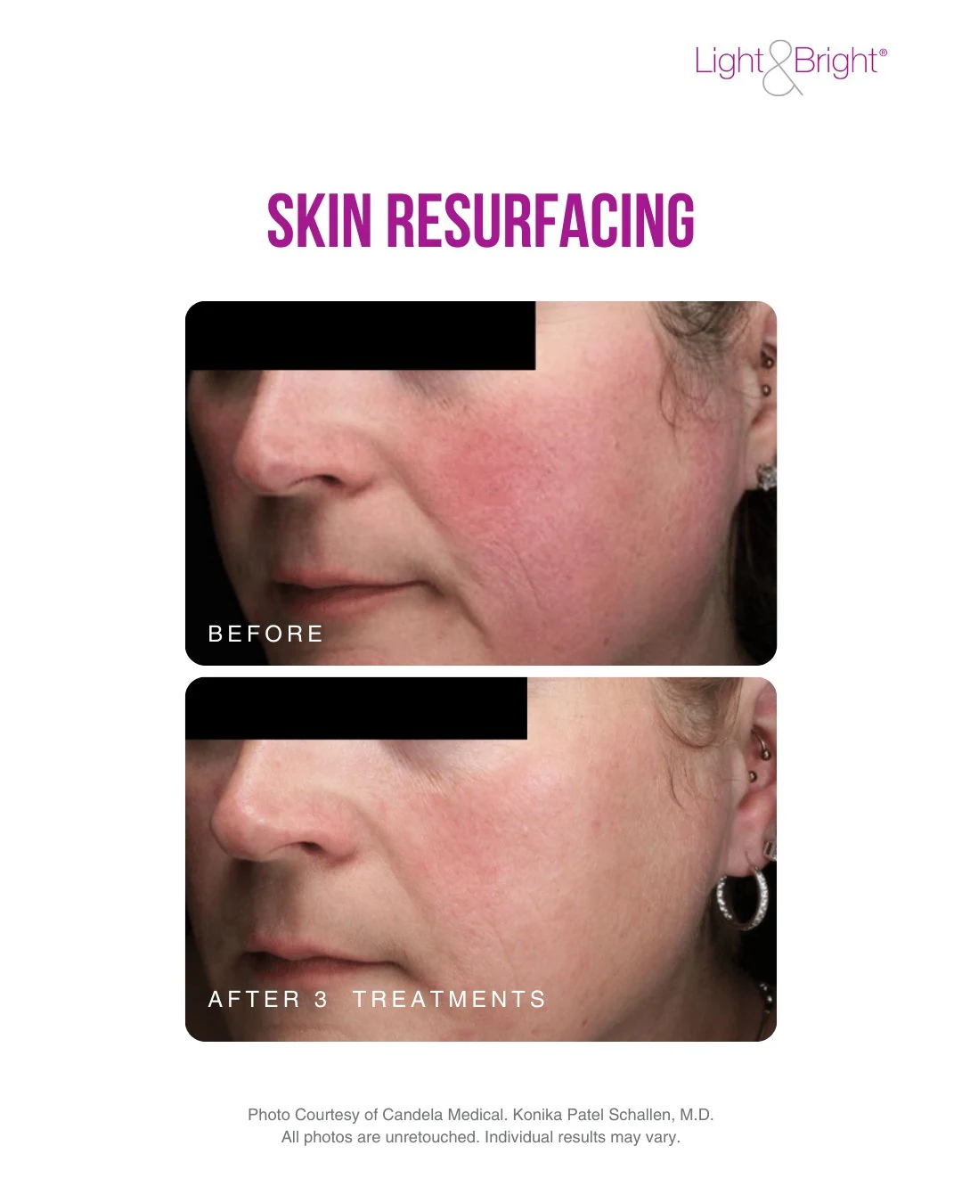 Before and after photos of smoother skin texture following three Nordlys laser skin resurfacing treatments