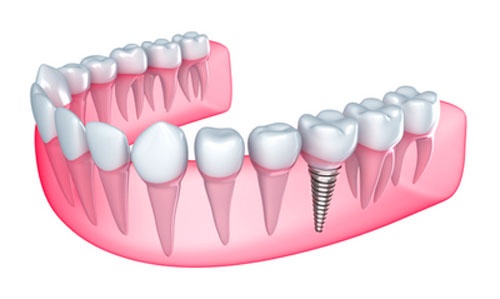 Types of Dental Implants