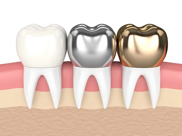 3D rendered cross-section view of three teeth with dental crowns made of different materials